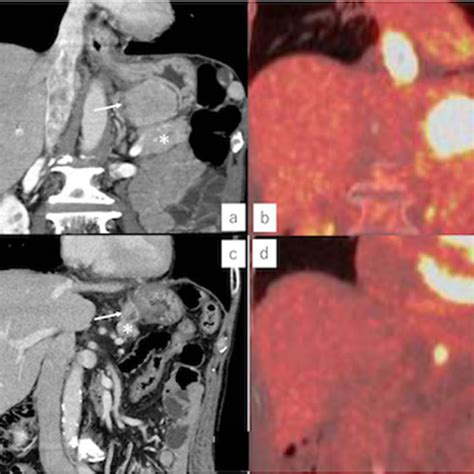 A Computed Tomography Ct Showed A 65 Mm Swollen Lymph Node Invading