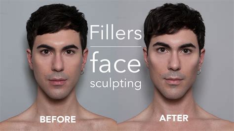 Non Surgical Filler Injections For Men Cheeks And Chin Face Sculpting