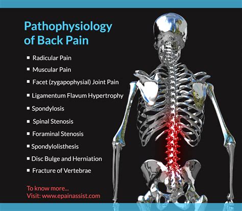 Pathophysiology Of Back Pain Or Backacheradicularmuscularfacet