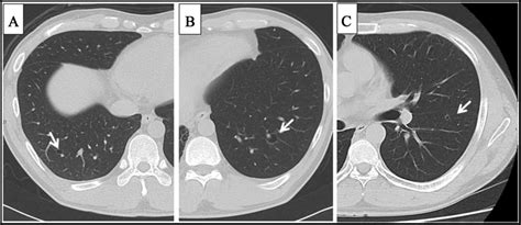 An Unusual Presentation Of Pneumothorax Associated With Cystic Lung