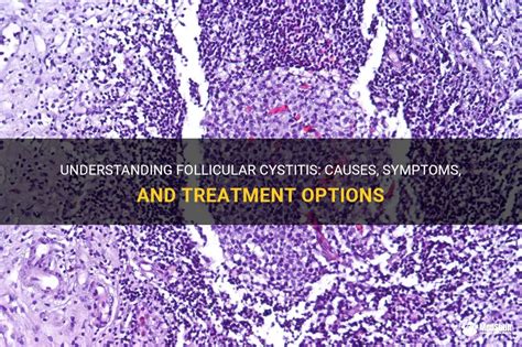 Understanding Follicular Cystitis Causes Symptoms And Treatment
