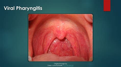 Viral Pharyngitis Pictures Picturemeta