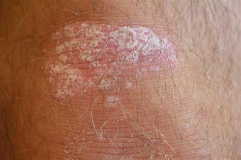 Psoriasis On The Knee Stock Image Image Of Dermatopathy 71907931
