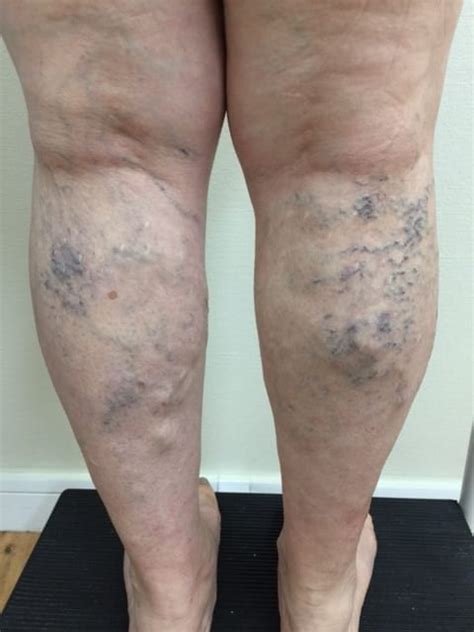 Varicose Veins Before And After For Non Surgical Vein Treatment