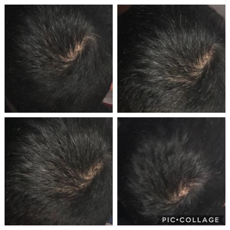Hairloss Community Advice Is This Normal Crown Or Initial Stages Of
