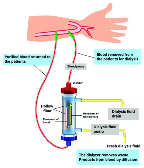 The Procedure Of Hemodialysis A Patient Is Connected To A Dialysis
