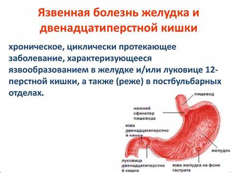 Прободная язва двенадцатиперстной кишки: симптомы, как лечить Картинка - Прободная язва двенадцатиперстной кишки: симптомы, как лечить