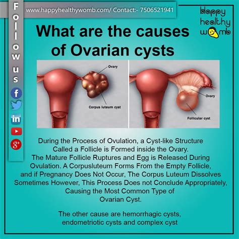 Can Complex Ovarian Cysts Cause Thyroid Problems Coach M Morris