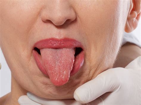 Warning Signs Your Tongue Could Be Sending About Your Health Business Insider