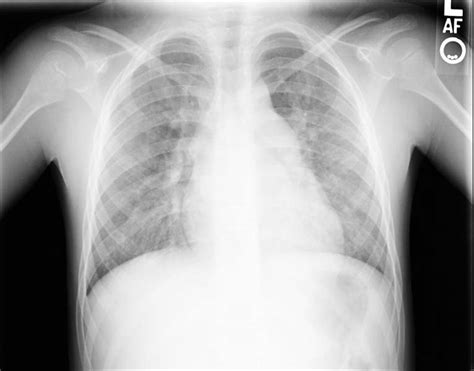 Atrial Septal Defect Chest X Ray Wikidoc