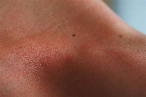 Why Sunburns Itch And How To Soothe Them Beautiful With Brains