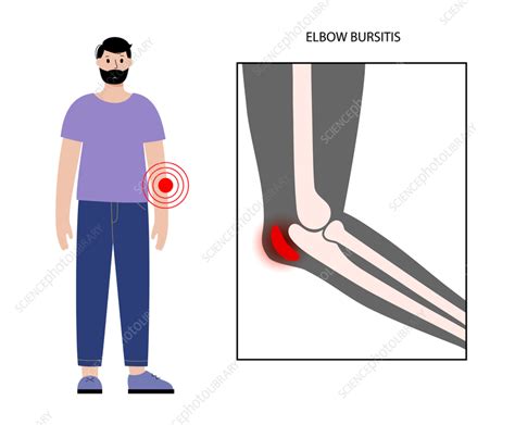 Elbow Bursitis Illustration Stock Image F0357429 Science Photo