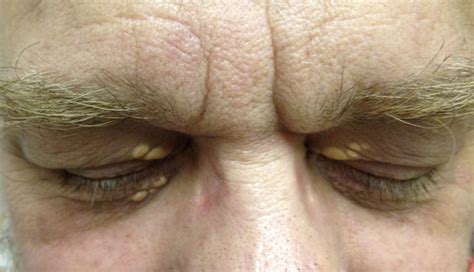 Derm Dx Yellowish Papules On The Eyelids Clinical Advisor
