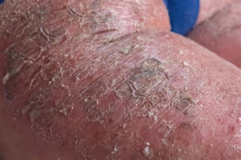 Closeup Of Cracked And Dry Skin Disease Medical Healthcare Concept