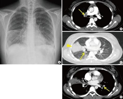 Chest X Ray Showed Patchy Consolidation On The Right Middle Lobe And