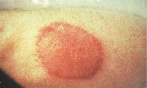Lyme Disease Disease Images Cfsph