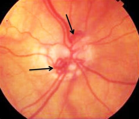 Central Retinal Vein Occlusion Disc Collaterals The Retina Reference