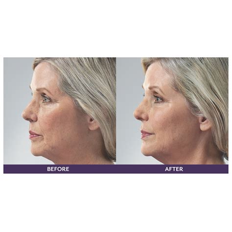 Facial Filler Before And After Feel Ideal 360 Med Spa Southlake Tx