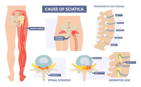 When Surgery Is Needed For Sciatica New Jersey Comprehensive Spine Care
