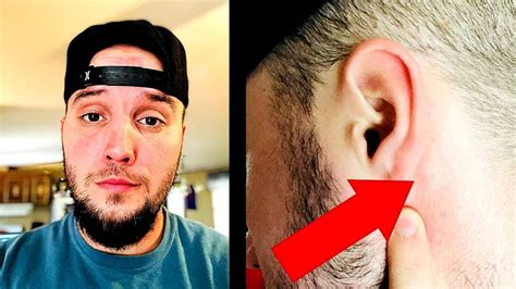 Big Update On The Lump Found Behind My Ear Youtube