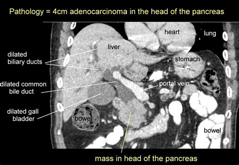 Pancreatic Protocol Ct Scan Pro Factory Plus Perspective