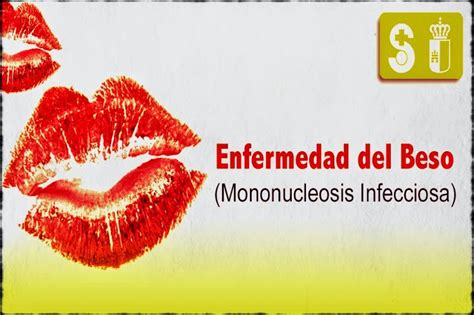 Pdf Enfermedad Del Beso Mononucleosis Infecciosa