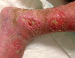 And the other 25% are being studied to what triggers them. Venous Ulcers: Prevention, Diagnosis and Treatment
