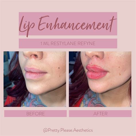 Lip Filler Before And After Lip Fillers Lip Enhancement Natural Lips