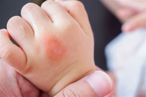 Flea Bites On Babies Pictures Treatment And Prevention