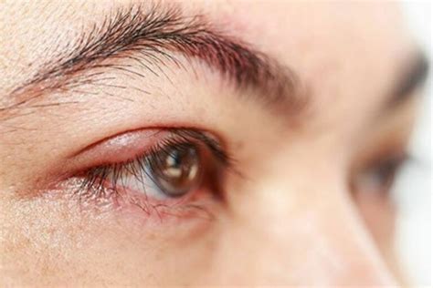 Causes Of White Bumps Under The Eyes Eye Conditions The Eye News