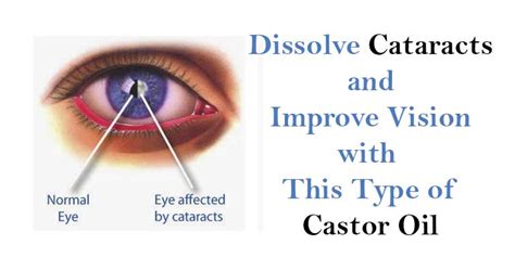 Learn the different benefits of applying castor oil on eyes and get youthful and beautiful eyes. How To Use Castor Oil To Dissolve Cataracts and Get 20/20 ...
