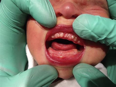 Exuberant Upper Gum Lesions In A Neonate The Journal Of Pediatrics