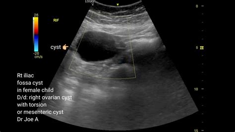 Right Iliac Fossa Cyst In Young Girl Right Ovarian Cyst Mesenteric