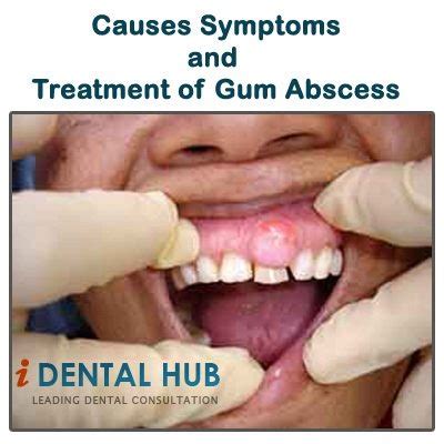 When left untreated, the abscess comes out via tissues of the. 18 best Gum Boil images on Pinterest | Home remedies ...