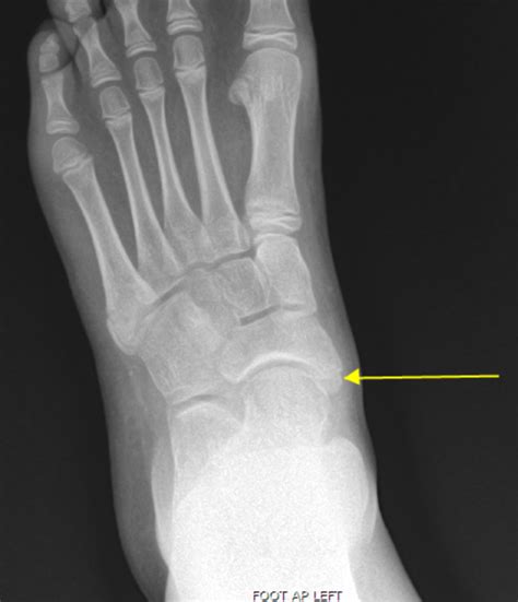 Treating The Accessory Navicular In Babe Athletes