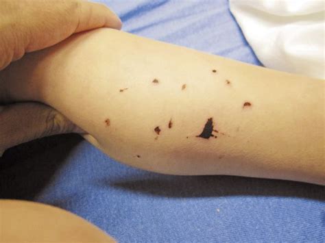 Tiny Black Dots On Hands Types Of Warts Symptoms Removal And