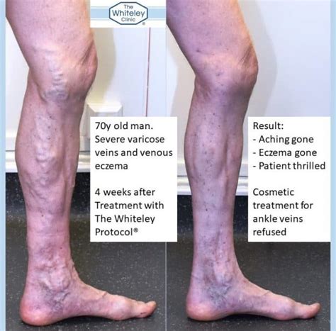 Varicose Eczema Cured By Whiteley Protocol The Whiteley Clinic