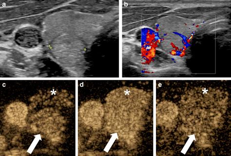 Right Thyroid Nodule That Was Incidentally Detected On A Ct Scan Of The