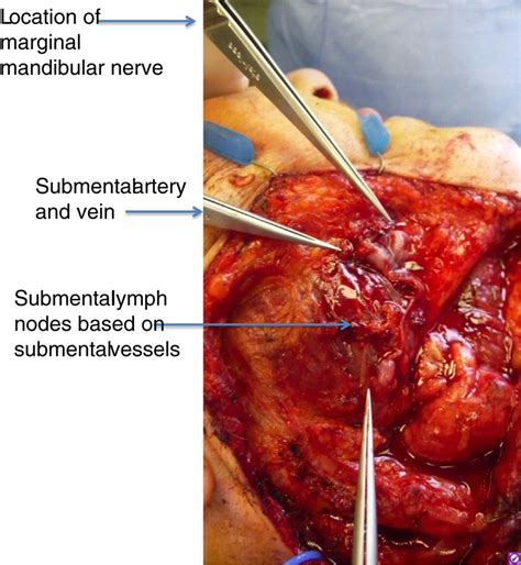 Intraoperative View Of Cervical Lymph Node Flap Level I Identifying