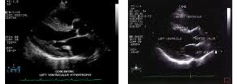 Echocardiography Long Axis Parasternal View Of The Patient Showing