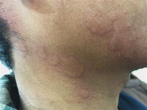 Stress Rash On Face Identification Causes And Treatments