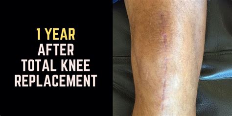 1 Year After Knee Replacement Surgery 12 Months Of Healing