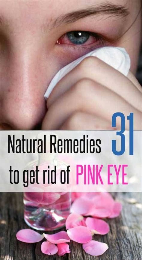 31 Home Remedies To Get Rid Of Pink Eyes With Images Pinkeye