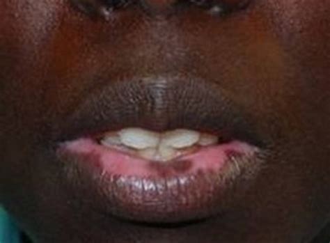 Health Tipswhite Spots On Lips Causes Pictures Lower