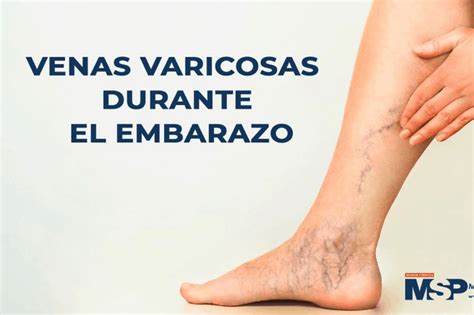 Venas Varicosas Durante El Embarazo