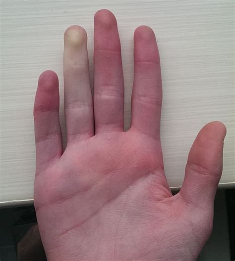 Scleroderma And Raynauds Phenomenon Cold Weathers Influence On Skin