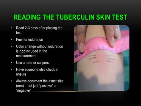 Ppt Tuberculin Skin Testing Mantoux Tuberculin Skin Test Powerpoint