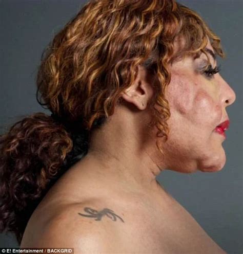 Transgender Activist Who Had Cement Fillers Has Third Corrective