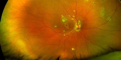 Management Of Presumed Ocular Histoplasmosis Syndrome American
