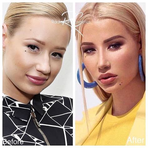 Best Of Plastic Surgery On Instagram “😐iggy Azalea Has Never Had Work Done In My Opinion